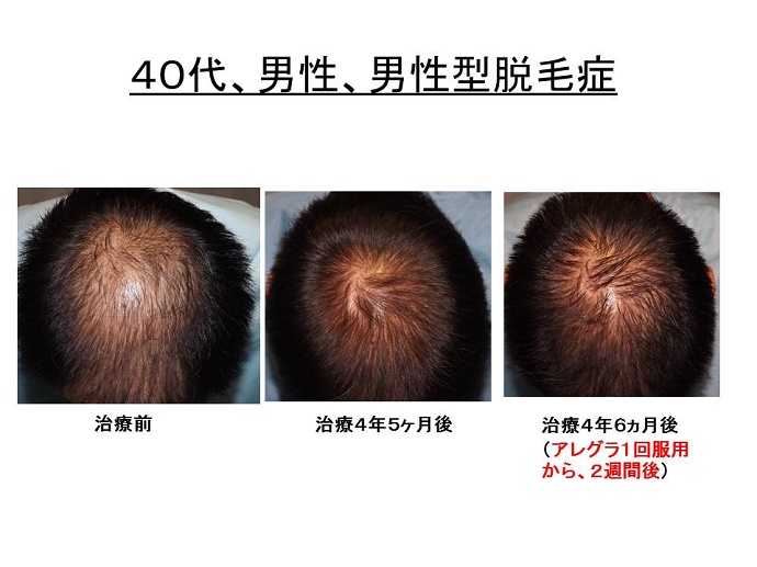円形脱毛症　病院""